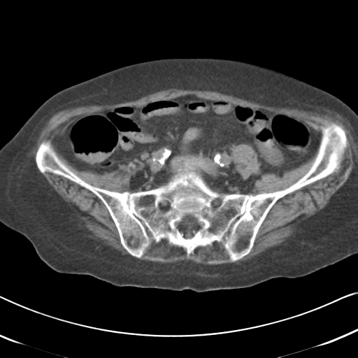 Active bleeding from duodenal ulcer with embolization (Radiopaedia 34216-35481 Axial non-contrast 46).png