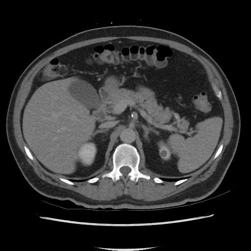 File:Active colonic bleed on CT (Radiopaedia 49765-55025 Axial C+ delayed 25).jpg