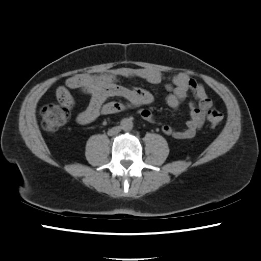 Active colonic bleed on CT (Radiopaedia 49765-55025 Axial non-contrast 47).jpg