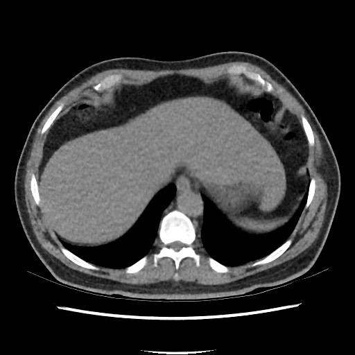 Active colonic bleed on CT (Radiopaedia 49765-55025 Axial non-contrast 9).jpg