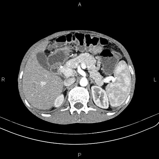 Active crohn disease (Radiopaedia 87133-103397 Axial C+ arterial phase 33).jpg