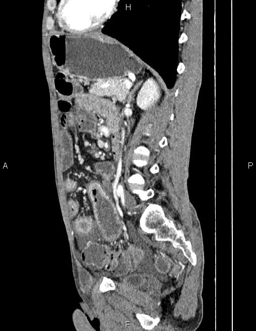 Active crohn disease (Radiopaedia 87133-103397 Sagittal C+ arterial phase 56).jpg