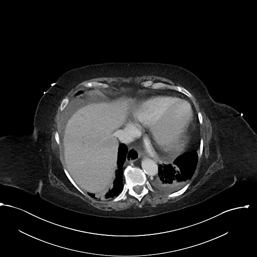File:Active renal extravasation with large subcapsular and retroperitoneal hemorrhage (Radiopaedia 60975-68796 Axial 337).jpg
