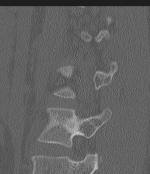 File:Acute L1 burst compression fracture (Radiopaedia 34430-35755 Sagittal bone window 47).png