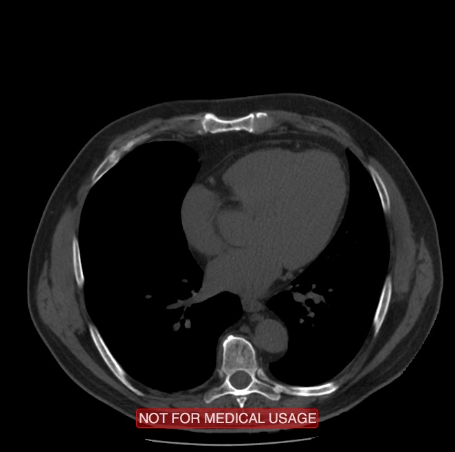 Acute aortic dissection - Stanford type A (Radiopaedia 40661-43285 Axial non-contrast 40).jpg