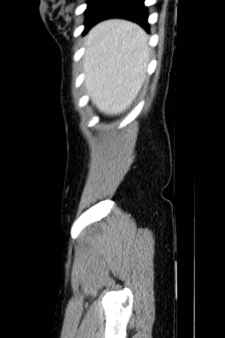 Acute appendicitis (Radiopaedia 22892-22918 Sagittal C+ portal venous phase 6).png