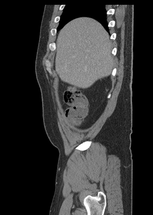 Acute appendicitis (Radiopaedia 48511-53463 Sagittal C+ portal venous phase 30).jpg