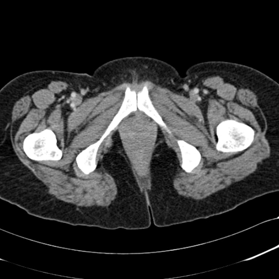 File:Acute appendicitis (Radiopaedia 48792-53822 Axial C+ portal venous phase 126).jpg