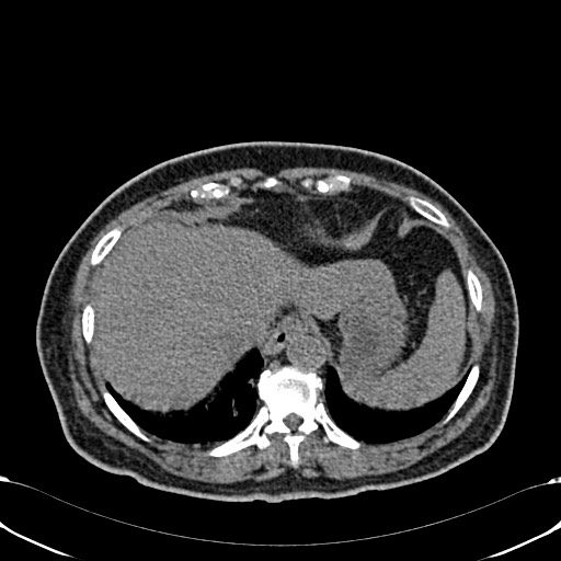 Acute appendicitis (Radiopaedia 58627-65818 Axial non-contrast 13).jpg