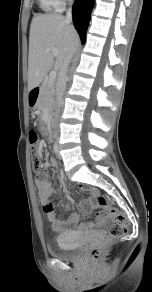 Acute appendicitis (Radiopaedia 62608-70901 Sagittal C+ portal venous phase 21).jpg
