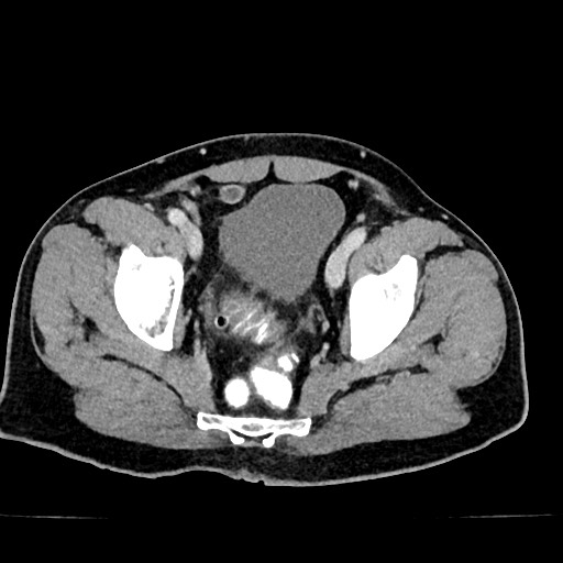 Acute appendicitis (Radiopaedia 77016-88960 Axial C+ portal venous phase 126).jpg