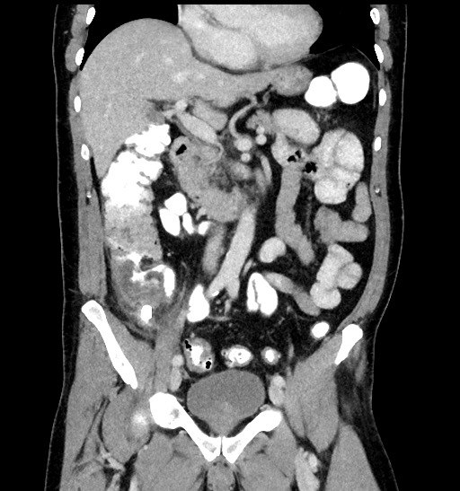 File:Acute appendicitis (Radiopaedia 77016-88960 Coronal C+ portal venous phase 47).jpg