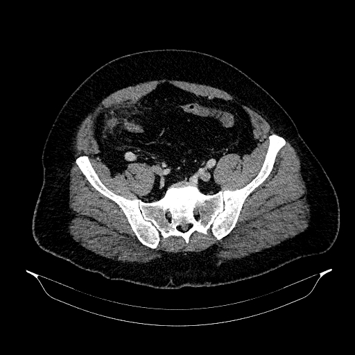 File:Acute appendicitis (Radiopaedia 79950-93224 Axial C+ portal venous phase 80).jpg