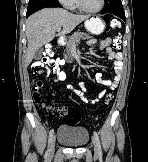 Acute appendicitis (Radiopaedia 84780-100240 Coronal C+ portal venous phase 29).jpg