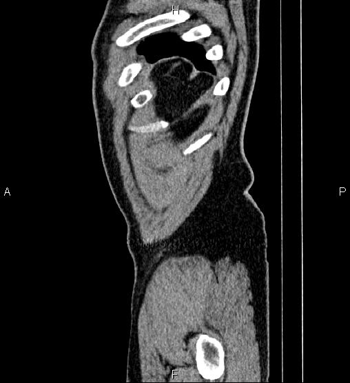 Acute appendicitis (Radiopaedia 84780-100240 Sagittal C+ portal venous phase 104).jpg