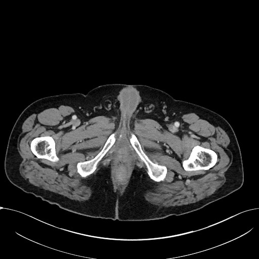 File:Acute appendicitis - large appendicoliths (Radiopaedia 61805-69820 Axial C+ portal venous phase 144).jpg