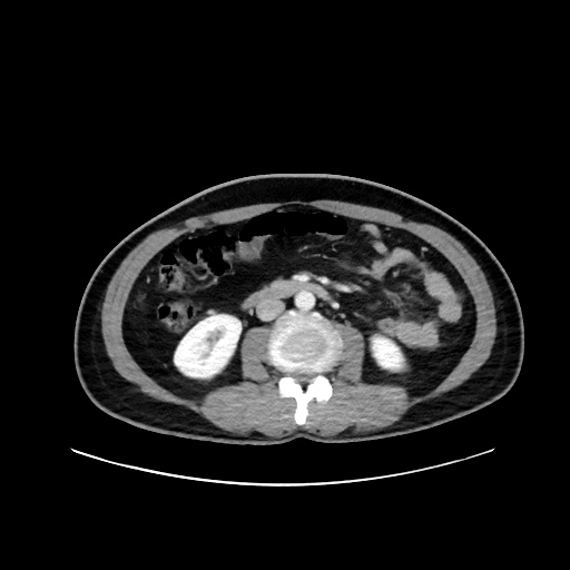 Acute appendicitis and COVID 19 pneumonia (Radiopaedia 76604-88380 Axial C+ portal venous phase 39).jpg