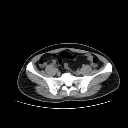 Acute appendicitis and COVID 19 pneumonia (Radiopaedia 76604-88380 Axial non-contrast 100).jpg