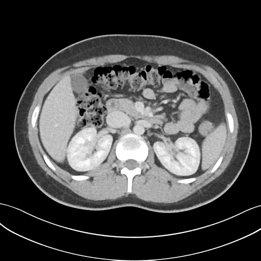 Acute appendicitis with appendicoliths (Radiopaedia 50186-55532 Axial C+ portal venous phase 29).png