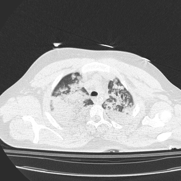 Acute aspiration pneumonitis (Radiopaedia 33605-34703 Axial lung window 24).jpg