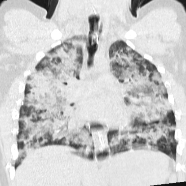 Acute aspiration pneumonitis (Radiopaedia 33605-34703 Coronal lung window 44).jpg