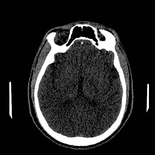 Acute basilar artery occlusion (Radiopaedia 43582-46985 Axial non-contrast 97).jpg