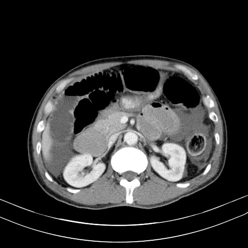 Acute bowel ischemia (Radiopaedia 87695-104114 Axial C+ portal venous phase 31).jpg