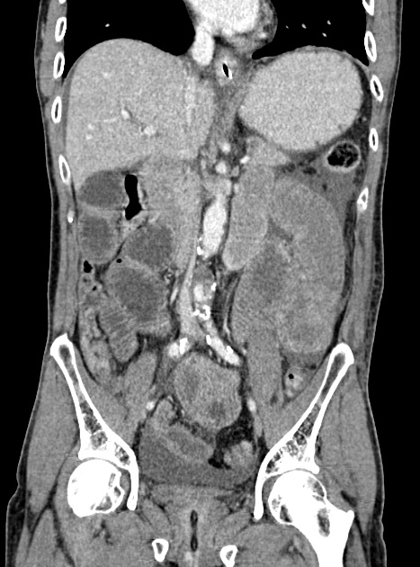 Acute bowel ischemia (Radiopaedia 87695-104114 Coronal C+ portal venous phase 206).jpg