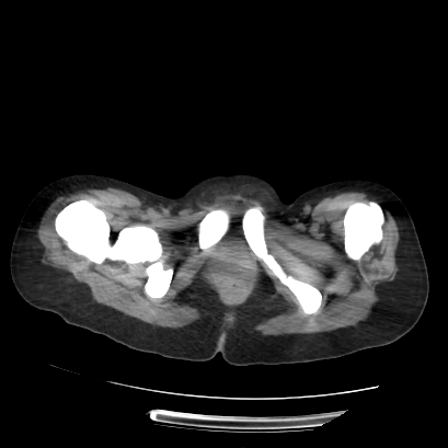 File:Acute calculous cholecystitis in patient with osteopetrosis (Radiopaedia 77871-90159 Axial non-contrast 81).jpg