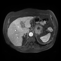 File:Acute cholecystitis complicated by pylephlebitis (Radiopaedia 65782-74915 Axial arterioportal phase T1 C+ fat sat 36).jpg