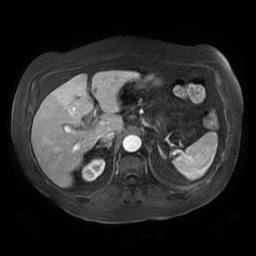 Acute cholecystitis complicated by pylephlebitis (Radiopaedia 65782-74915 Axial arterioportal phase T1 C+ fat sat 44).jpg