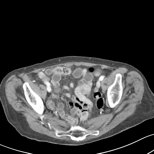 File:Acute cholecystitis with contained perforation (Radiopaedia 47328-51907 Axial C+ portal venous phase 60).png