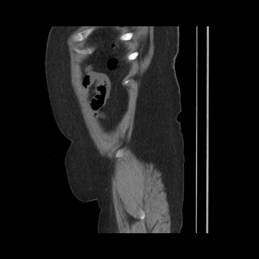 Acute cholecystitis with tensile fundus sign (Radiopaedia 71394-81723 Sagittal non-contrast 146).jpg