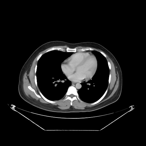 File:Acute complicated calculous cholecystitis (Radiopaedia 55202-61587 Axial C+ delayed 11).jpg
