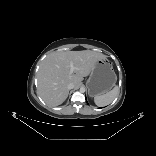 File:Acute complicated calculous cholecystitis (Radiopaedia 55202-61587 Axial C+ delayed 27).jpg