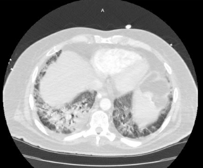 Acute cor pulmonale (ultrasound) (Radiopaedia 83508-98818 Axial lung window 66).jpg