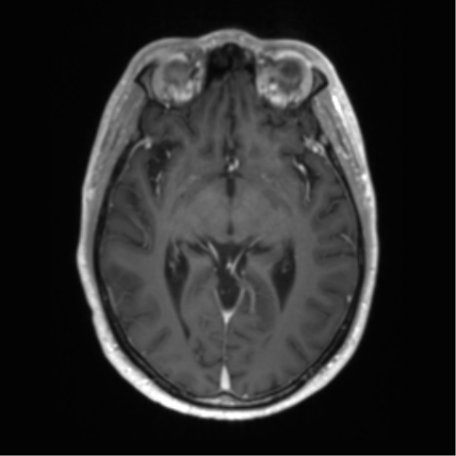 Acute disseminated encephalomyelitis (ADEM) (Radiopaedia 65319-74350 Axial T1 C+ 26).png