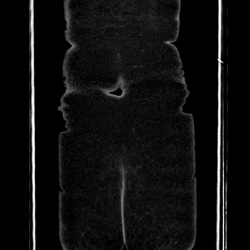 Acute diverticulitis - transverse colon (Radiopaedia 87063-103327 Coronal C+ portal venous phase 159).jpg