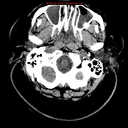 Acute hemorrhagic leukoencephalitis (Radiopaedia 14076-43697 Axial non-contrast 2).jpg