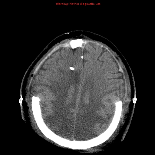 Acute hemorrhagic leukoencephalitis (Radiopaedia 14076-43697 Axial non-contrast 37).jpg