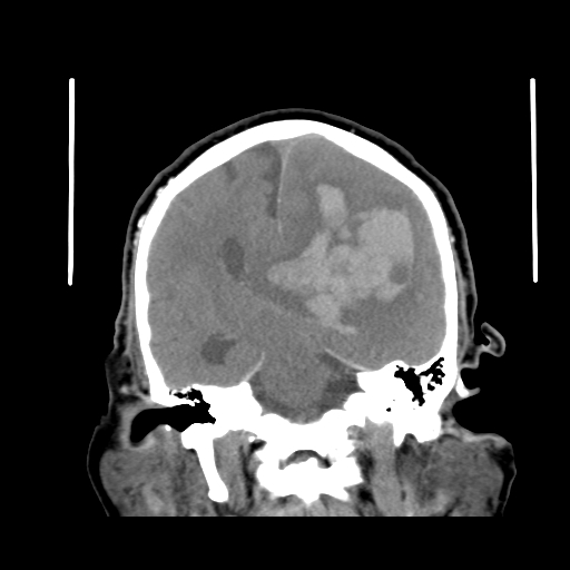File:Acute hemorrhagic stroke (Radiopaedia 17507-17223 Coronal non-contrast 30).jpg