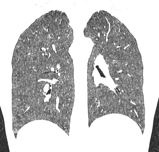 Acute hypersensitivity pneumonitis (Radiopaedia 85293-100870 Coronal lung window 85).jpg