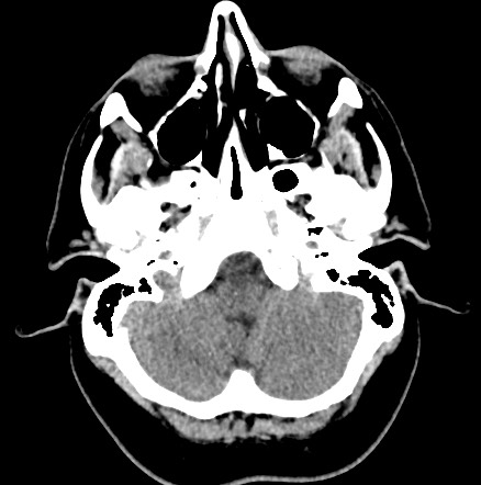 Acute internal carotid artery dissection (Radiopaedia 53541-59558 Axial non-contrast 10).jpg