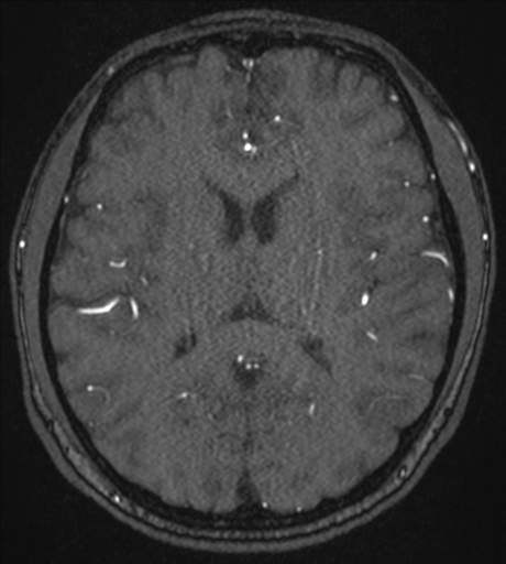Acute left middle cerebral artery territory infarct with clot retrieval (Radiopaedia 47732-52433 Axial MRA 37).png