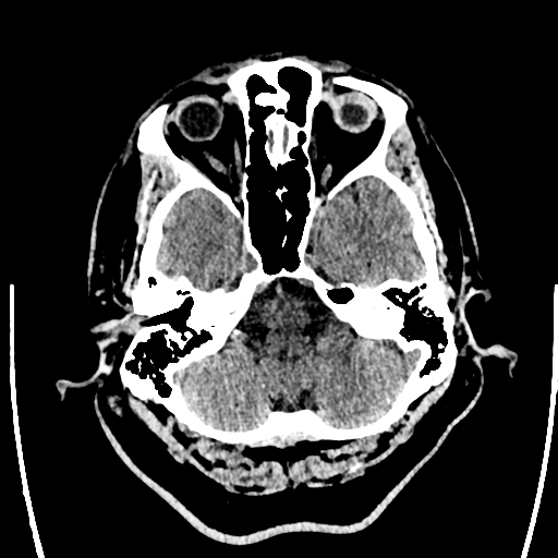 Acute left middle cerebral artery territory ischemic stroke (Radiopaedia 35688-37223 Axial non-contrast 14).png
