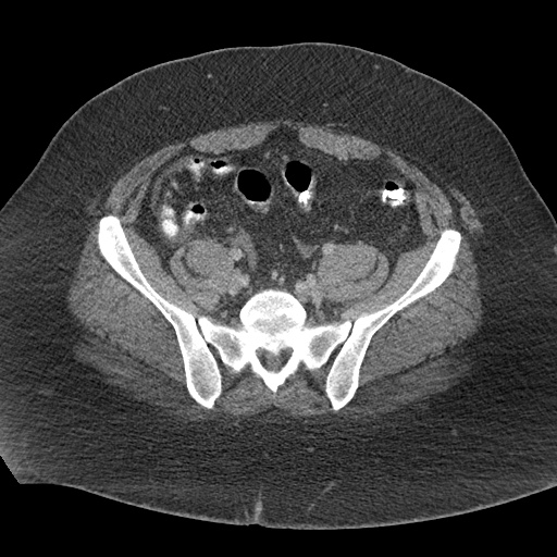File:Acute mesenteric venous ischemia (Radiopaedia 46041-50383 Axial C+ portal venous phase 105).jpg