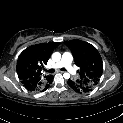 Acute myocardial infarction in CT (Radiopaedia 39947-42415 Axial C+ arterial phase 56).jpg