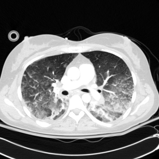 Acute myocardial infarction in CT (Radiopaedia 39947-42415 Axial lung window 55).jpg