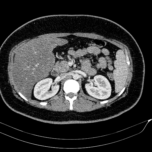 Acute on chronic pancreatitis (Radiopaedia 80902-94423 Axial C+ portal venous phase 65).jpg