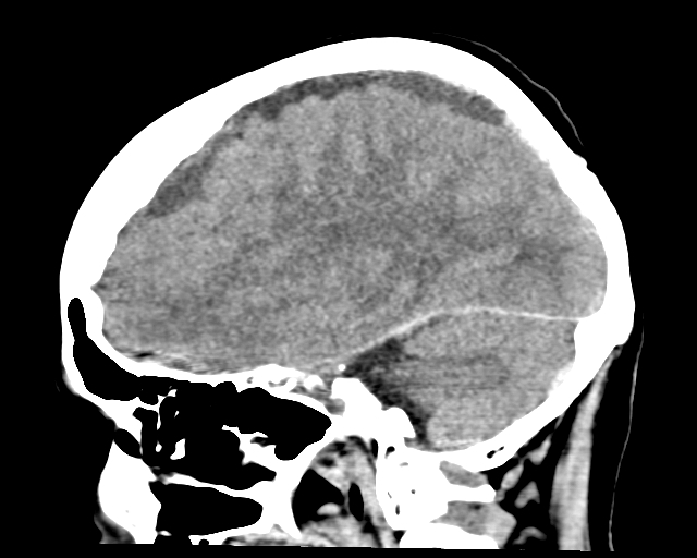 Acute on chronic subdural hemorrhage (Radiopaedia 85330-100923 Sagittal non-contrast 44).jpg